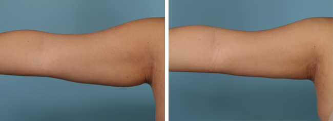 Brachioplasty: Cost, Recovery, Before and Afters of Arm Lift
