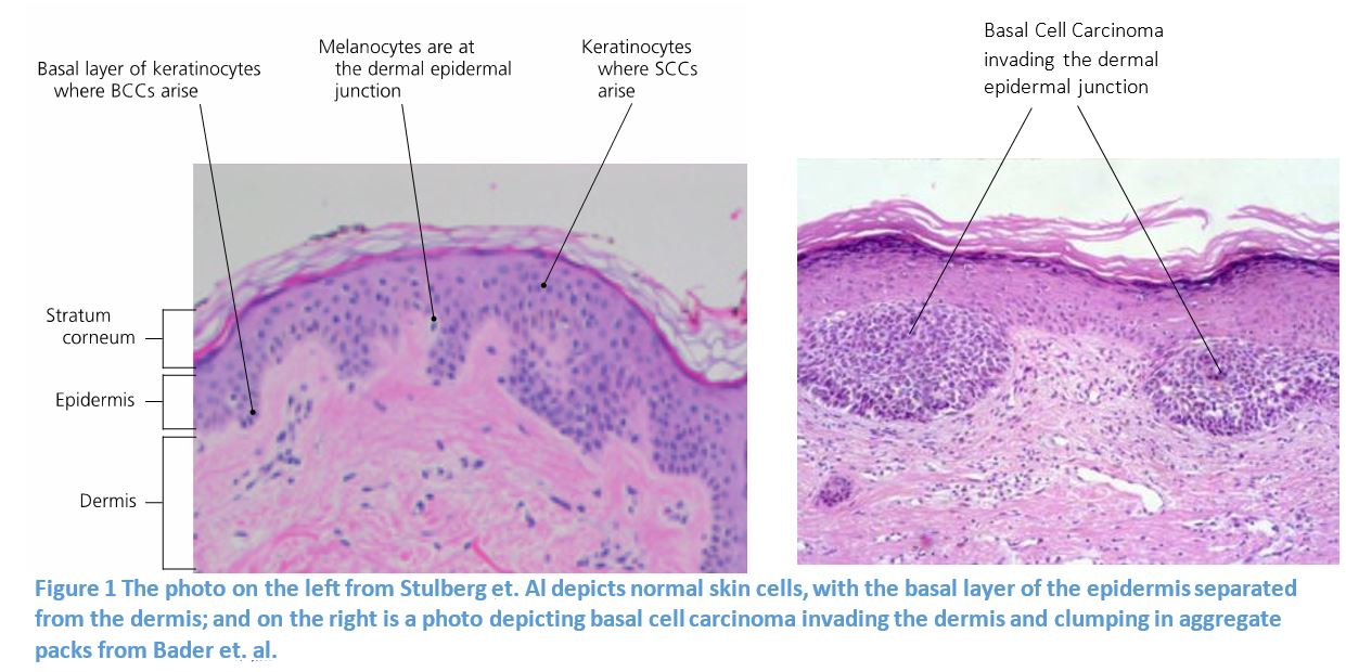 Mohs Surgery for Treatment of Basal Cell Carcinoma Dr