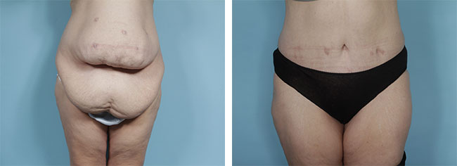 Full body Liposuction, Body contouring
